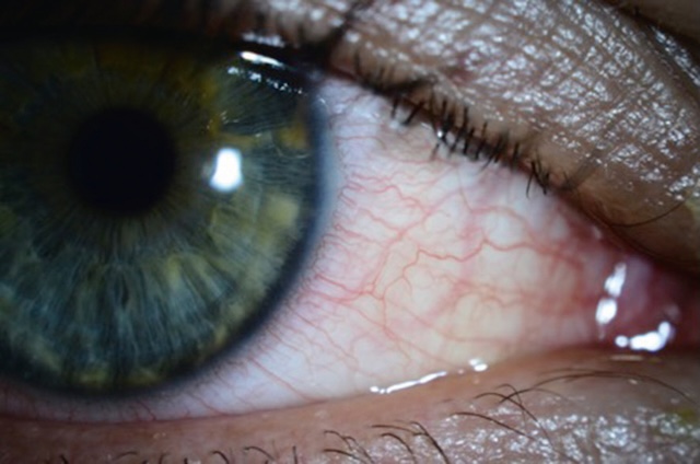 Légers œdème et rougeur conjonctivale liés à une conjonctivite allergique saisonnière, observés sur un œil sans signe d’infection active.