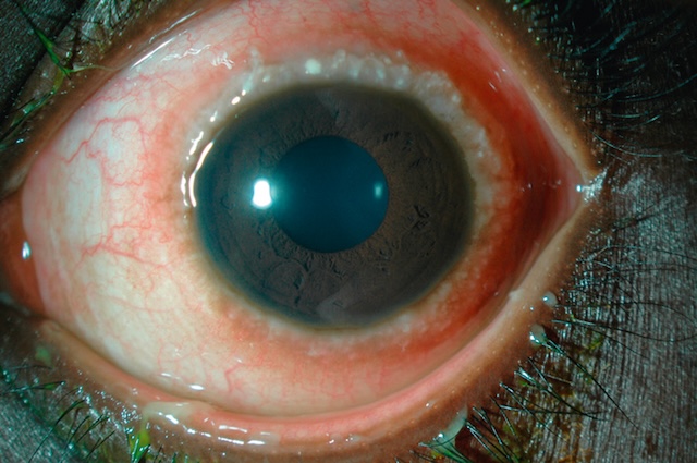 Gros plan d’un œil montrant un bourrelet inflammatoire au limbe et des grains de Trantas, signes typiques d’une allergie oculaire persistante.