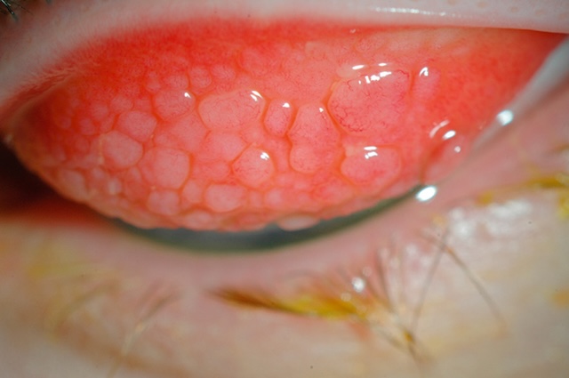Aspect tarsal fortement inflammatoire avec grandes papilles, typique d’une conjonctivite allergique marquée ou chronique.