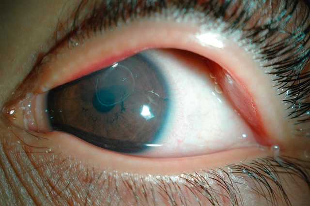 Ulcère cornéen vernale bien centré, à bord épithélial fin, dans un œil ouvert en grand, typique d’une inflammation allergique chronique.