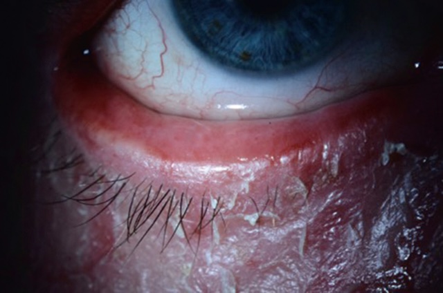 Ectropion inflammatoire avec eczéma sévère et fibrose conjonctivale sur paupière inférieure gauche.