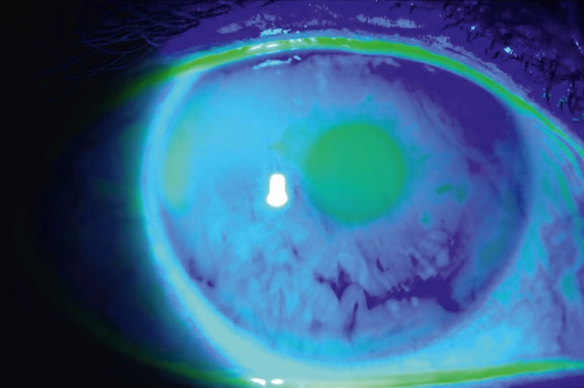 Vue sous fluorescéine montrant le temps de rupture du film lacrymal, indicateur de sécheresse oculaire.