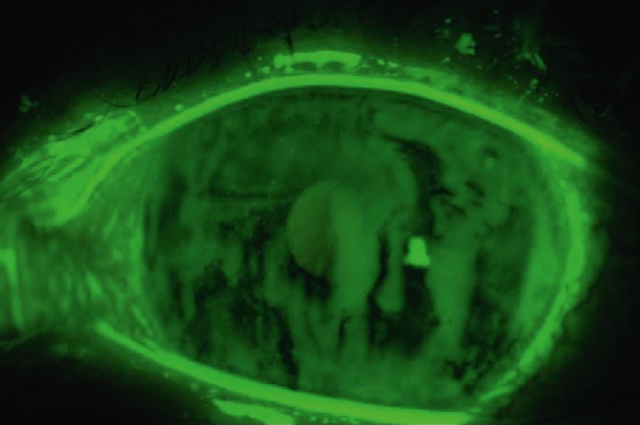 Cornée marquée par une rupture du film lacrymal et un marquage épithélial diffus en fluorescence.