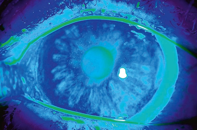 Vue fluorescéinique d’un œil montrant une sécheresse oculaire avec kératopathie diffuse.