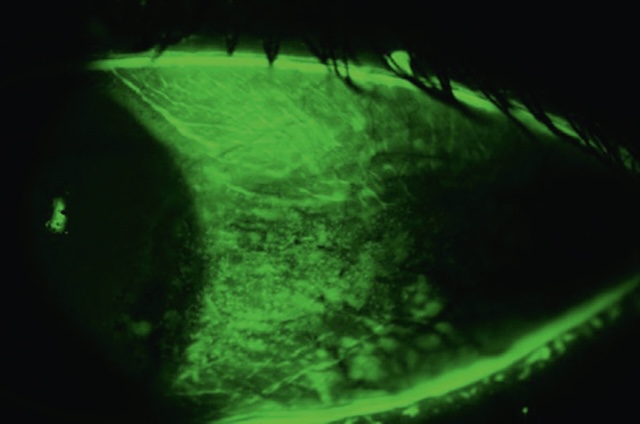 Image en lumière bleue après fluorescéine montrant des lésions diffuses de kératoconjonctivite sèche avec atteinte épithéliale dans l’espace interpalpébral.