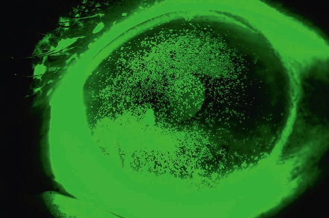 Coloration à la fluorescéine montrant des lésions cornéennes diffuses dans l’aire interpalpébrale, typiques de sécheresse oculaire sévère.