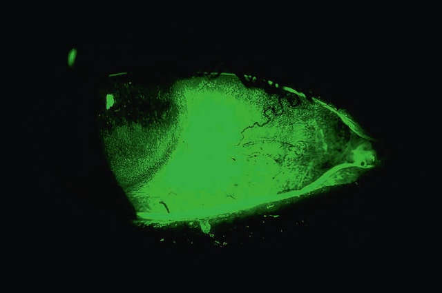 Kératoconjonctivite sèche avec marquage épithélial interpalpébral diffus sous fluorescence à la fluorescéine.