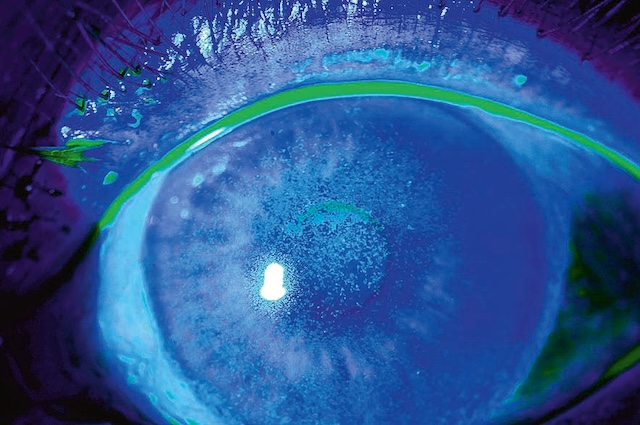 Image à la fluorescéine montrant un œil avec film lacrymal instable. Signes subtils de kératoconjonctivite sèche, visibles en fluorescence ponctuelle.