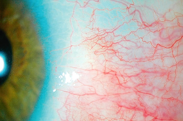 Zone nodulaire surélevée entourée de vaisseaux dilatés, typique d’une épisclérite localisée.