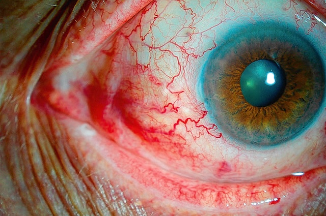 Photographie d’épisclérite nasale avec congestion vasculaire localisée et dilatation marquée des vaisseaux superficiels vers la région nasale.