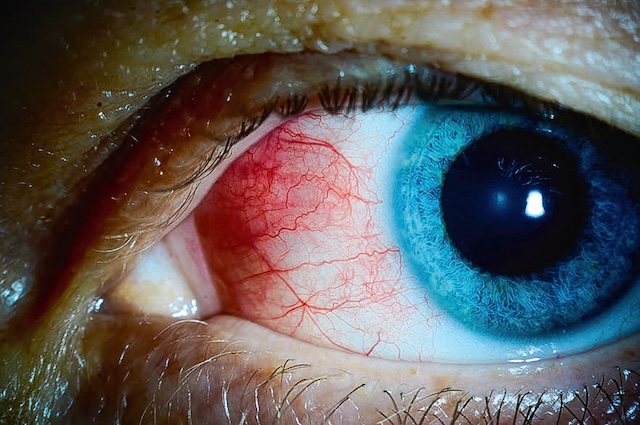 Inflammation localisée et superficielle des vaisseaux épiscléraux du côté nasal de l’œil gauche, sans atteinte profonde.