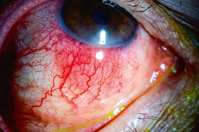 Nodule inflammatoire profond sur la sclère inférieure droite avec dilatation vasculaire intense et congestion marquée.