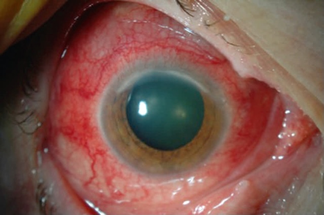 Sclérite marquée avec kératite ulcérante en zone périphérique supérieure. Inflammation sévère et congestion vasculaire profonde visibles à l’examen clinique.