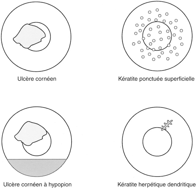 Schéma illustrant quatre types de kératites, dont ulcère, hypopion, herpétique et ponctuée superficielle.