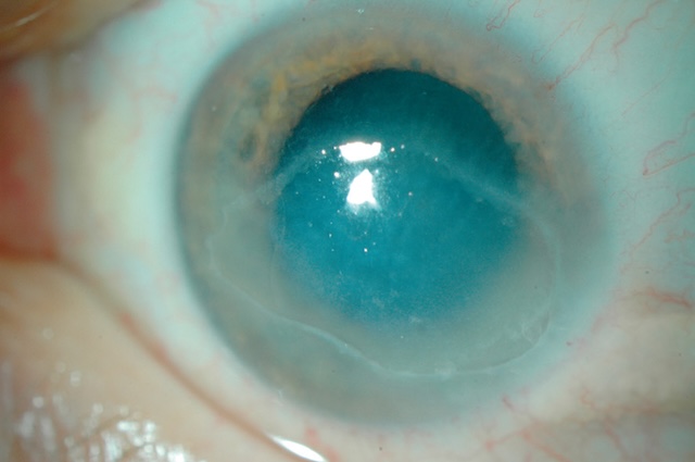 Image clinique d’un ulcère épithélial cornéen avec perte de transparence centrale et opacification blanchâtre bien délimitée de la surface cornéenne.