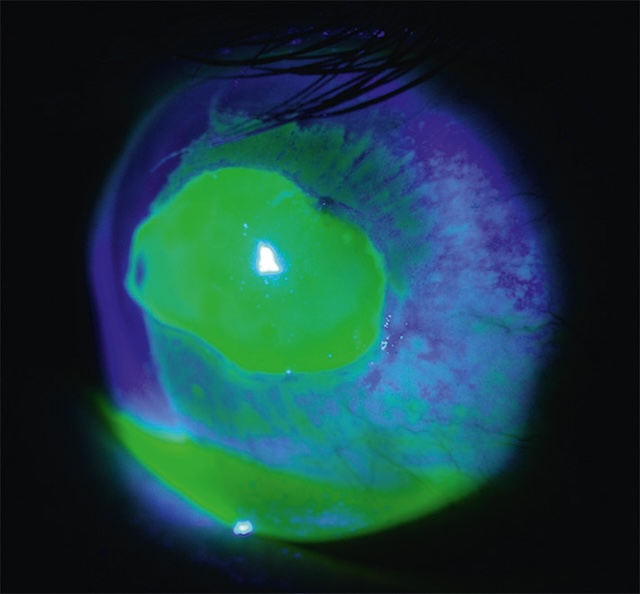 Coloration intense à la fluorescéine d’une large ulcération cornéenne observée sous lumière bleue.