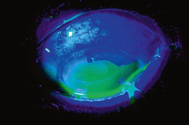 Ulcération cornéenne étendue avec chémosis conjonctival visible après brûlure chimique sous fluorescéine en lumière bleue.