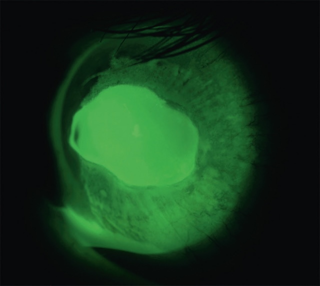 Grande érosion épithéliale cornéenne centrale bien visible à la fluorescéine. Lésion franche avec bord net, révélée par filtre jaune en lumière bleue.