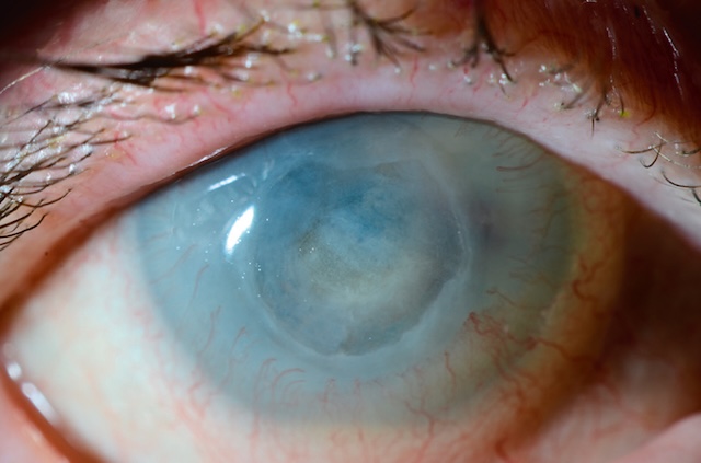 Cornée opacifiée avec ulcère creusant et néovascularisation périphérique typique d’un état inflammatoire chronique.