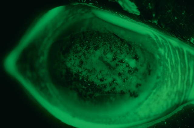 Image fluorescéinique montrant des microérosions cornéennes diffuses, typique d’une kératite épithéliale à adénovirus en phase initiale.