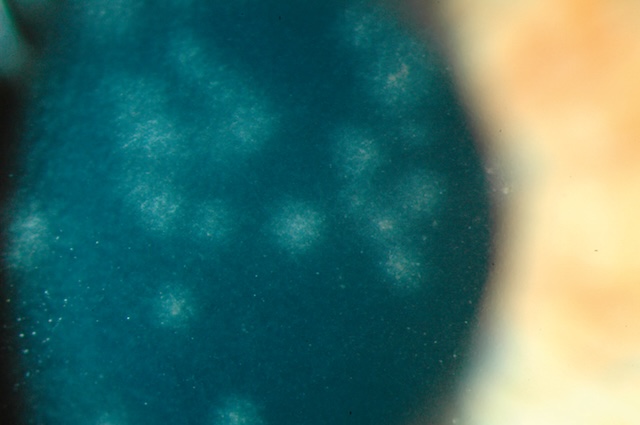 Présence de multiples opacités cornéennes diffuses, typiques d’une kératite adénovirale en phase inflammatoire.