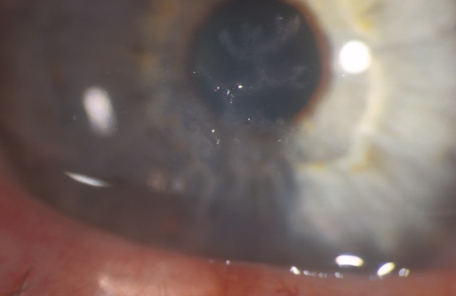 Ulcère dendritique central sur la cornée associé à une kératite herpétique active et localisée.