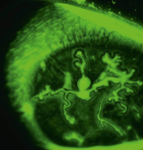 Ulcère dendritique cornéen hyperfluorescent visible après fluorescéine. Aspect ramifié classique d’une kératite herpétique active sous lumière filtrée.