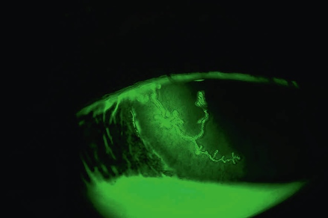 Lésion cornéenne ramifiée et fluorescente, caractéristique d’une kératite herpétique dendritique active.