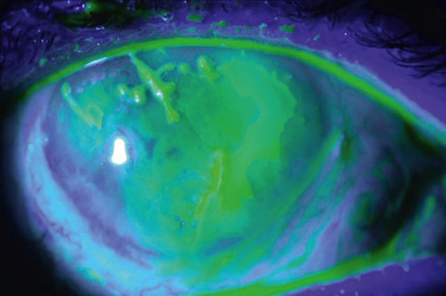 Vue fluorescéinique d’un ulcère géographique herpétique avec larges plages épithéliales rompues et contour ramifié très évocateur.