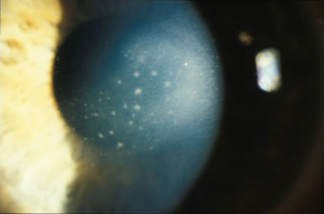 Œdème stromal disciforme central avec précipités rétrocornéens visibles, traduisant une kérato-uvéite active.