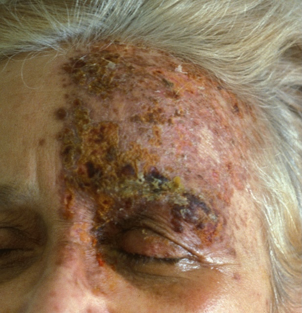 Zona ophtalmique étendu sur l’hémiface droite avec croûtes épaisses et inflammation aiguë. Lésions unilatérales suivant le trajet du nerf trijumeau.