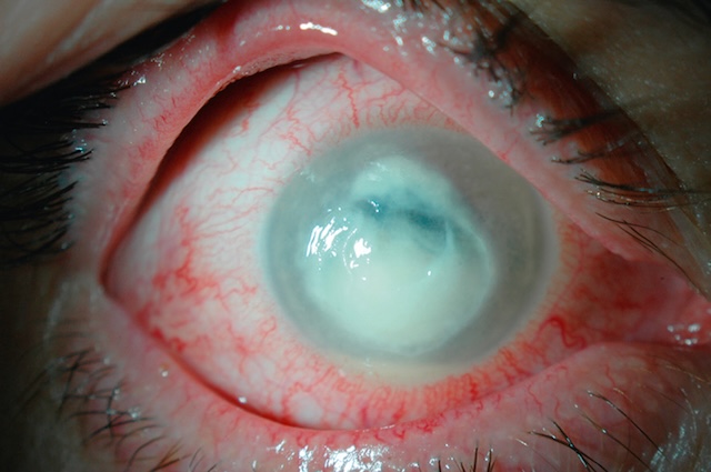 Infiltrat cornéen dense avec hypopion visible, traduisant une infection oculaire aiguë sévère.