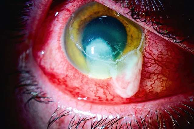 Photographie montrant un abcès cornéen bactérien avec infiltration blanche centrale, sécrétions épaisses et conjonctive fortement congestive.