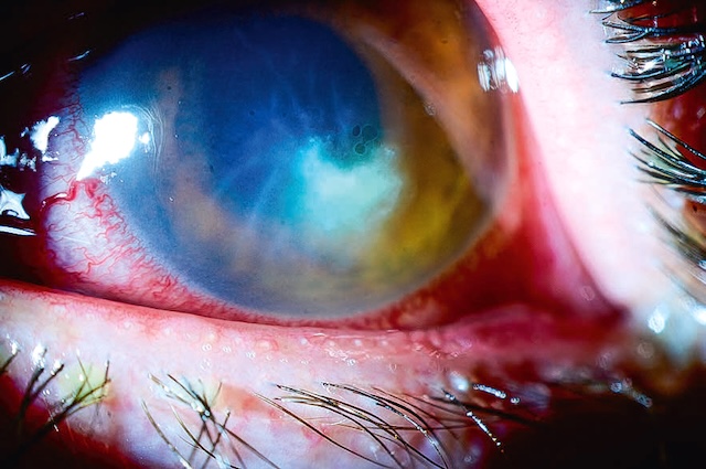 Infiltrat cornéen dense et profond, avec œdème stromal et hyperémie limbaire, typique d’un abcès fongique sévère.