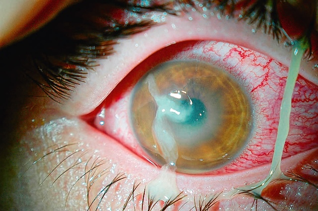 Opacité centrale cornéenne avec écoulement purulent et conjonctive congestive, tableau d’un abcès bactérien actif.