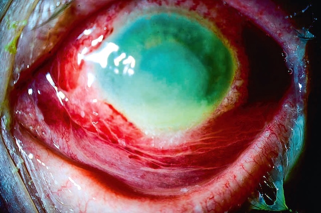 Abcès cornéen bactérien central dense avec sécrétions purulentes. Inflammation conjonctivale marquée et risque de complications sévères en l’absence de traitement.
