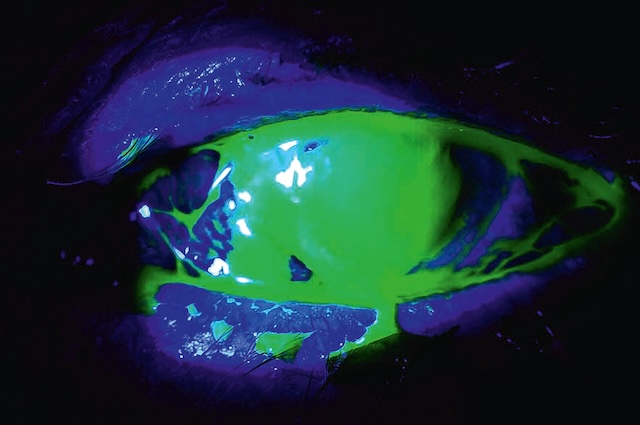 Coloration fluorescéinique marquant un abcès cornéen bactérien avec sécrétions purulentes étendues.