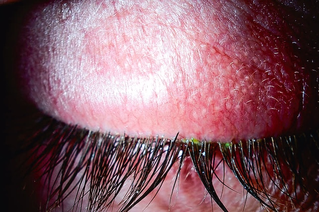 Vue rapprochée d’un œdème palpébral supérieur avec peau tendue et dépôts ciliaires, secondaire à une infection cornéenne active.