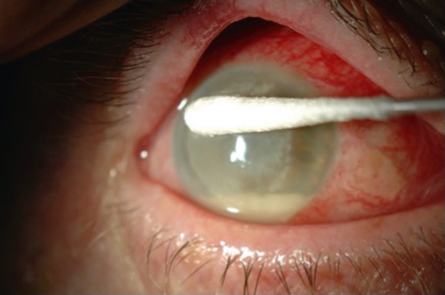 Prélèvement ciblé d’un abcès cornéen à l’aide d’un écouvillon, visant l’identification rapide du germe infectieux.