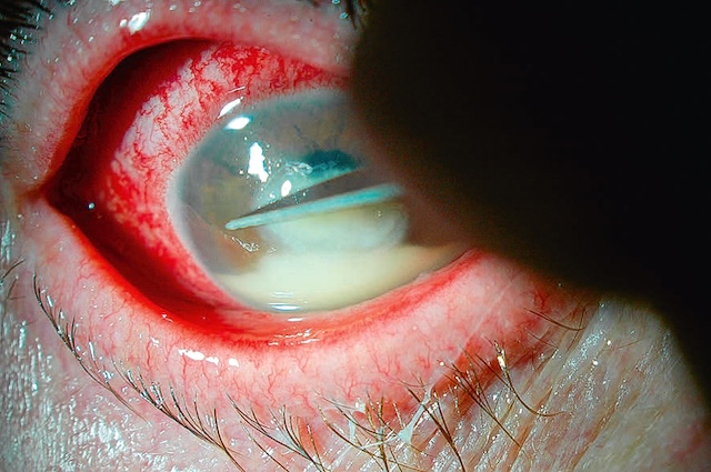 Prélèvement à la lame sur abcès cornéen purulent, réalisé au contact direct de l’infiltrat pour identification bactérienne.