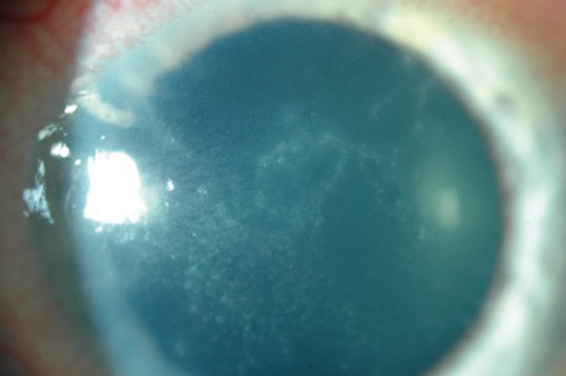 Kératite amibienne avec lésions épithéliales linéaires radiaires. Infiltrats diffus sur cornée œdémateuse, image typique d’une infection à Acanthamoeba.