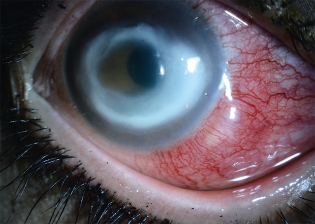 Anneau inflammatoire cornéo-scléral associé à une injection vasculaire, typique d’une sclérokératite amibienne.