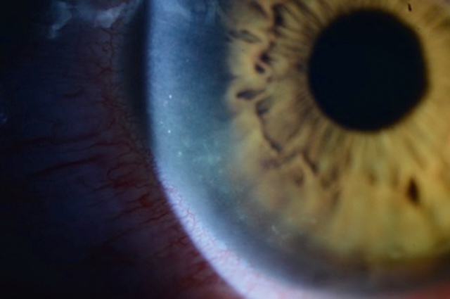 Vue en lampe à fente montrant plusieurs infiltrats cornéens périphériques, de petite taille, diffus et localisés en zone paracentrale inférieure.