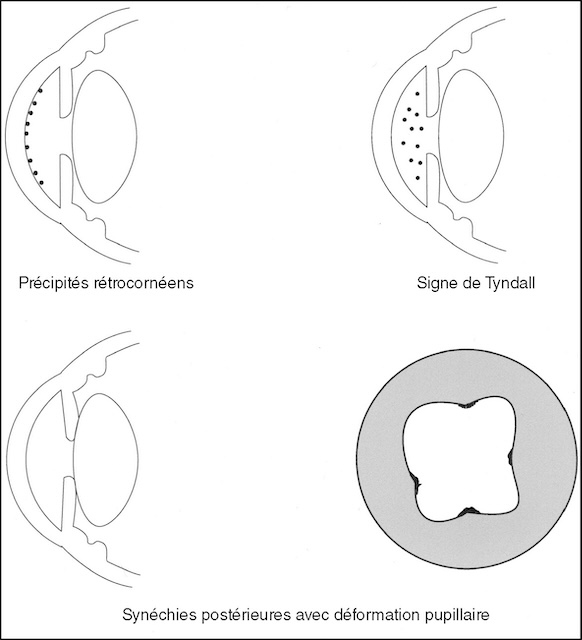 Schéma explicatif des signes cliniques majeurs d’uvéite antérieure : dépôts cellulaires, inflammation active, adhérences postérieures et pupille déformée.