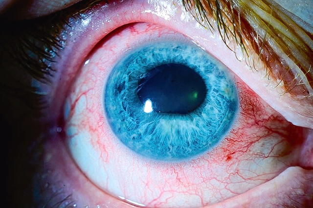 Injection ciliaire associée à une uvéite antérieure, avec synéchies postérieures entraînant une pupille irrégulière.