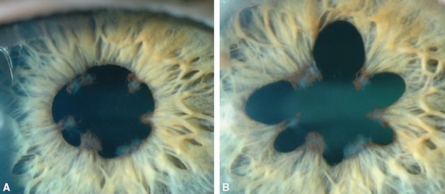 Synéchies iridocristalliniennes fixant la pupille, visibles avant et après dilatation. Séquelles d’uvéite antérieure avec déformation pupillaire persistante.