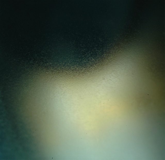 Aspect voilé de la cornée lié à des précipités fins rétrodescémétiques d’une uvéite antérieure.