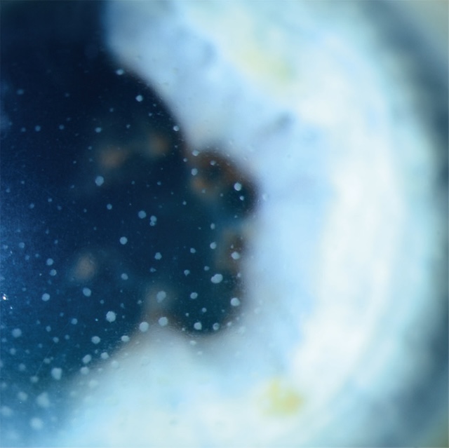 Image en lampe à fente montrant des précipités rétrocornéens granulomateux, signes caractéristiques d’une uvéite antérieure active.