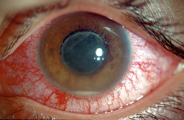 Œil enflammé avec hypopion et bouchon cyclitique sur uvéite liée à une spondylarthrite ankylosante, inflammation intense de la chambre antérieure.