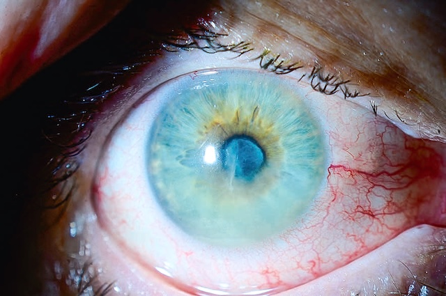 Uvéite antérieure aiguë avec hypopion visible et membrane cyclitique marquant une inflammation sévère.